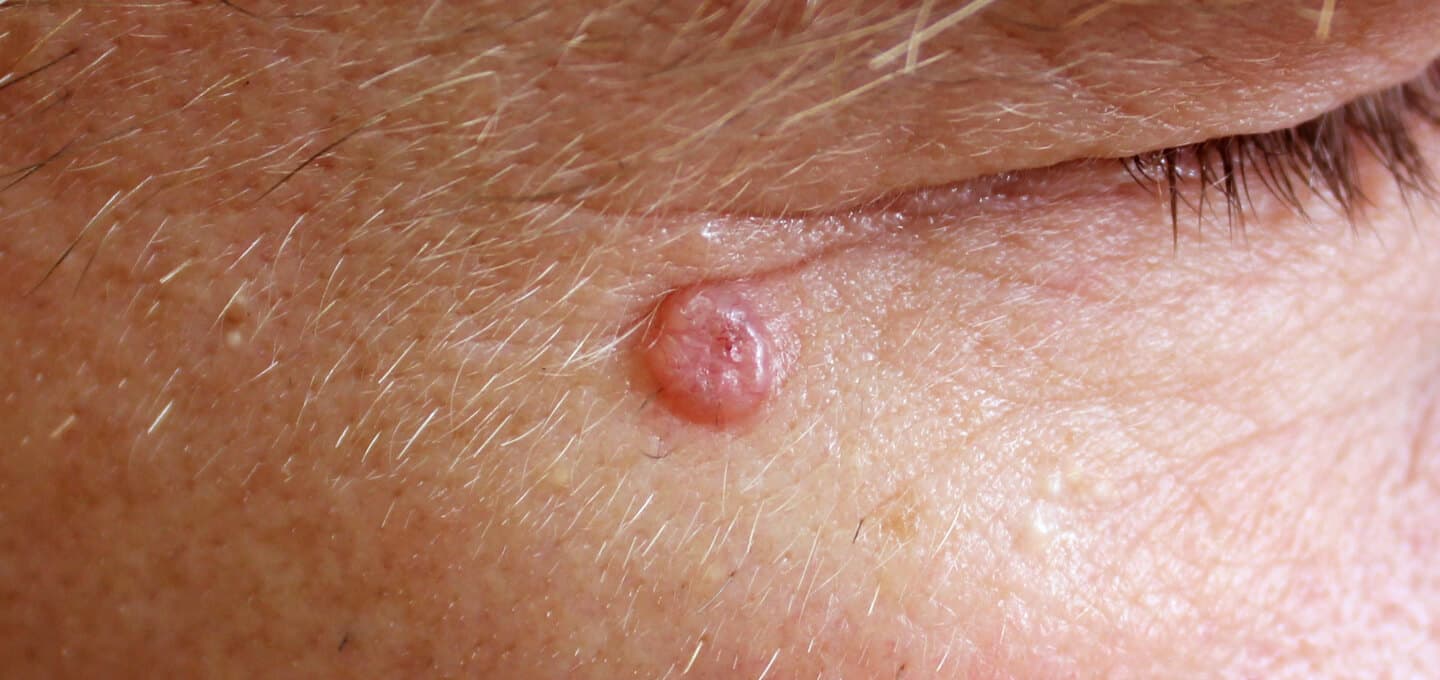 Pearly pink nodule on the skin beside the eye, typical of basal cell carcinoma, a common form of skin cancer.