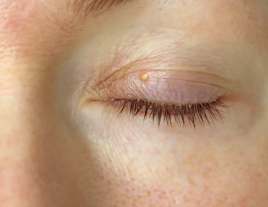 Close-up of a small yellowish xanthelasma papule on the upper eyelid near the lashes.