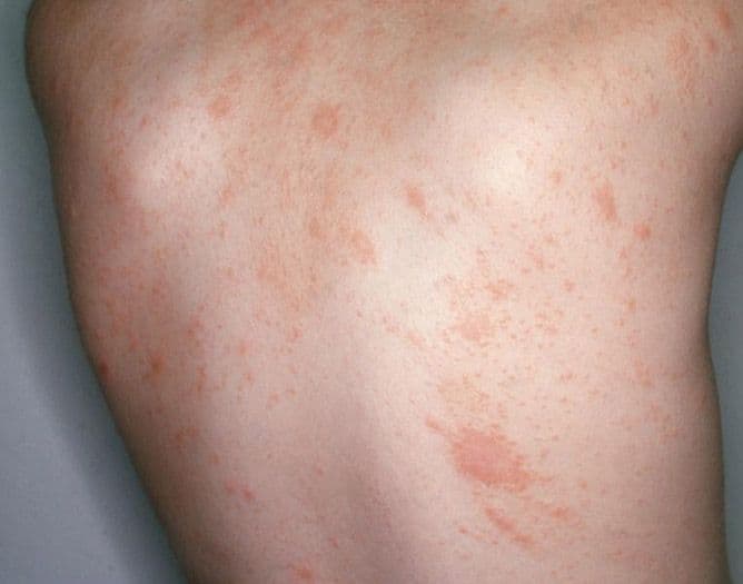 Pityriasis rosea showing a rash of pink scaly spots spread over the back and flank.