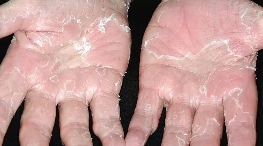 Both palms with peeling skin syndrome, skin shedding in large sheets to reveal reddened skin underneath.