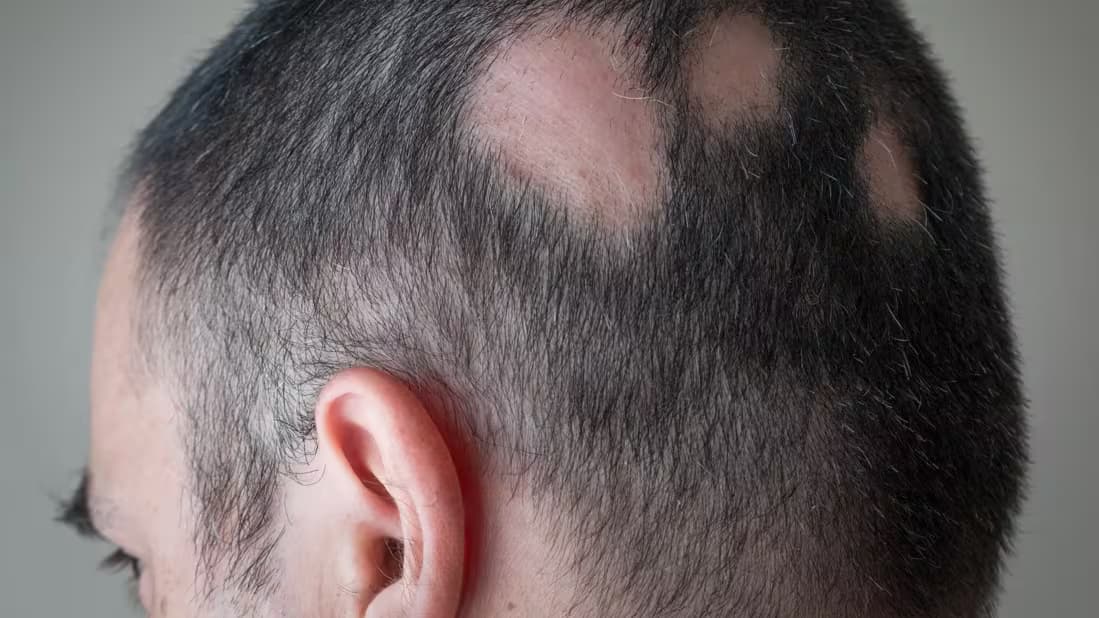 Person with alopecia areata showing clearly defined bald patches across the hair-bearing scalp