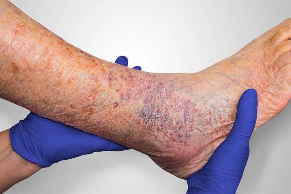 Gloved hands examining a lower leg with brownish pigmentation and inflammation of stasis dermatitis