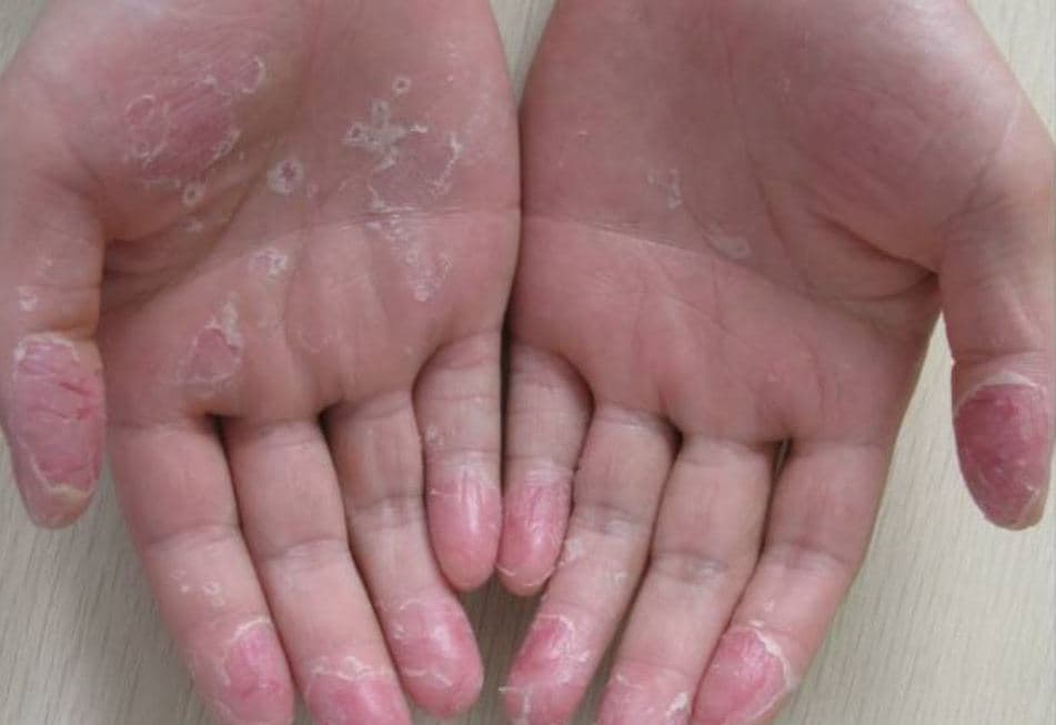 Peeling, dry and reddened skin on the palms and fingers with dystrophic nails, typical of exfoliative keratolysis.