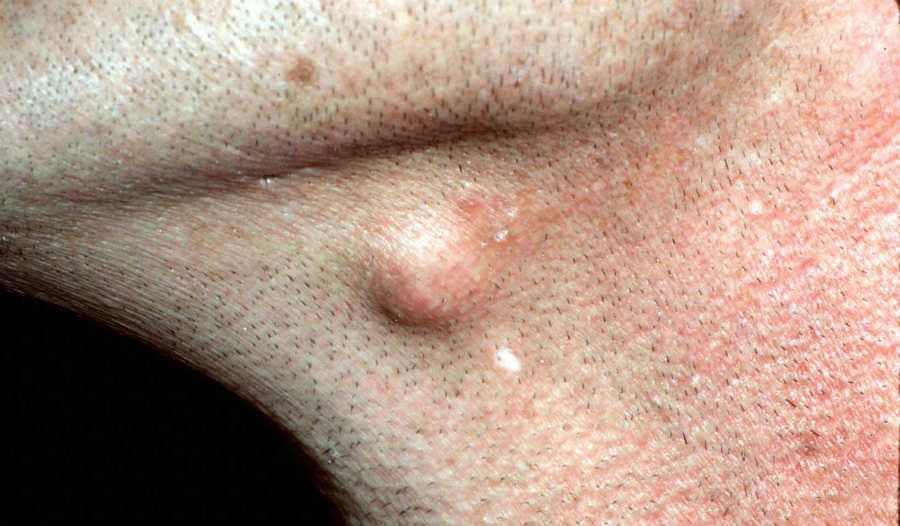Skin-coloured epidermoid cyst with a central punctum in the neck area