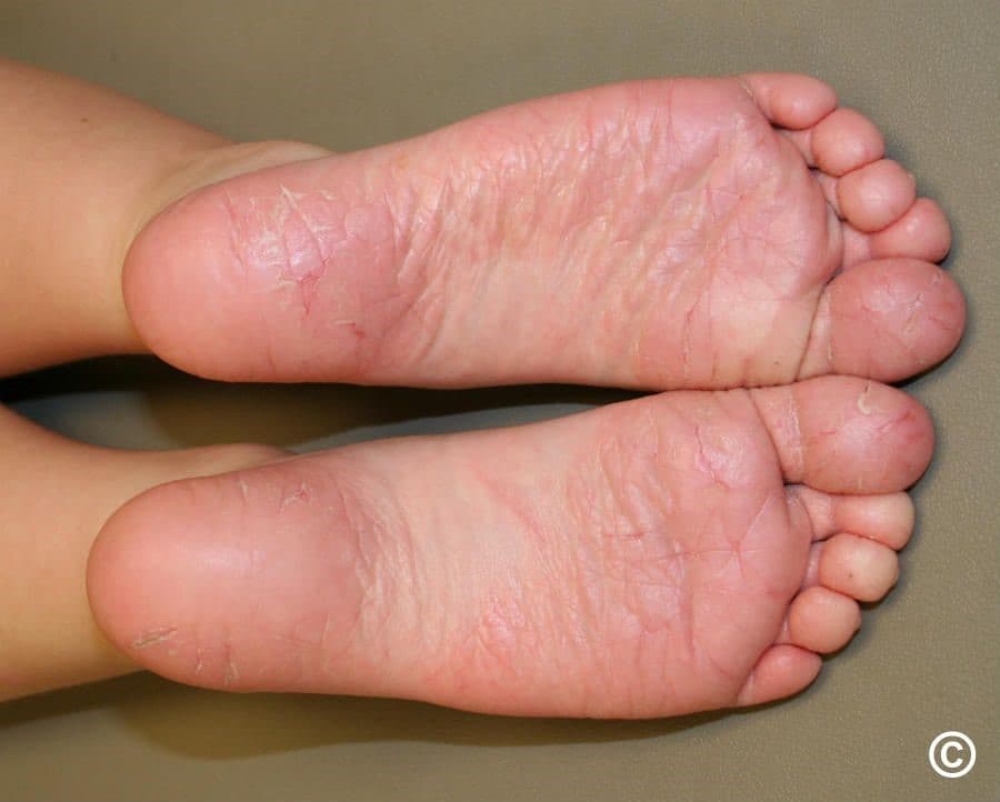 Dry, cracked and glazed skin on the soles of a child's feet with fine scaling, typical of juvenile plantar dermatosis.