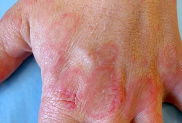 Reddened target-shaped lesions on the back of the hand, characteristic of erythema multiforme.