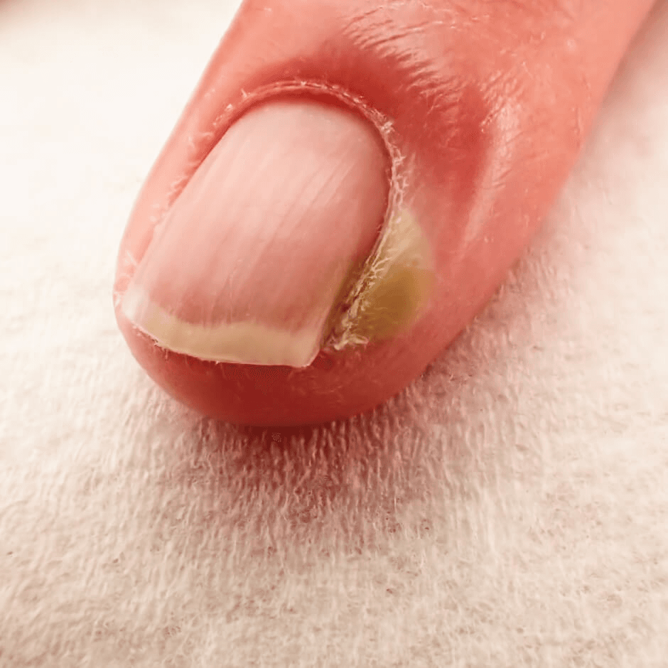 Swollen, reddened nail fold with a yellowish discolored nail edge on a finger, typical of chronic paronychia.