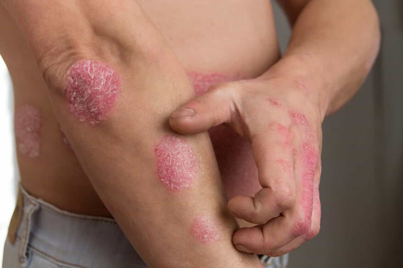 Person scratching red scaly psoriasis plaques on the elbow and arms needing a dermatologist's help.