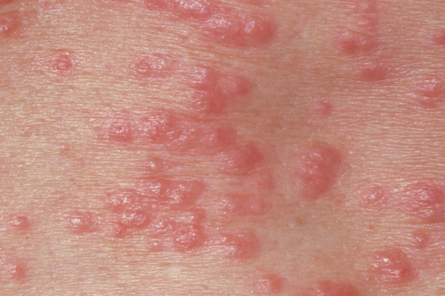 Numerous red inflamed papules and rash on the skin typical of contagious scabies.