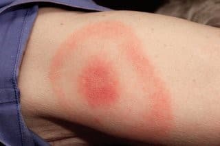 Classic bull's-eye erythema migrans rash on the arm, a characteristic sign of early Lyme disease.