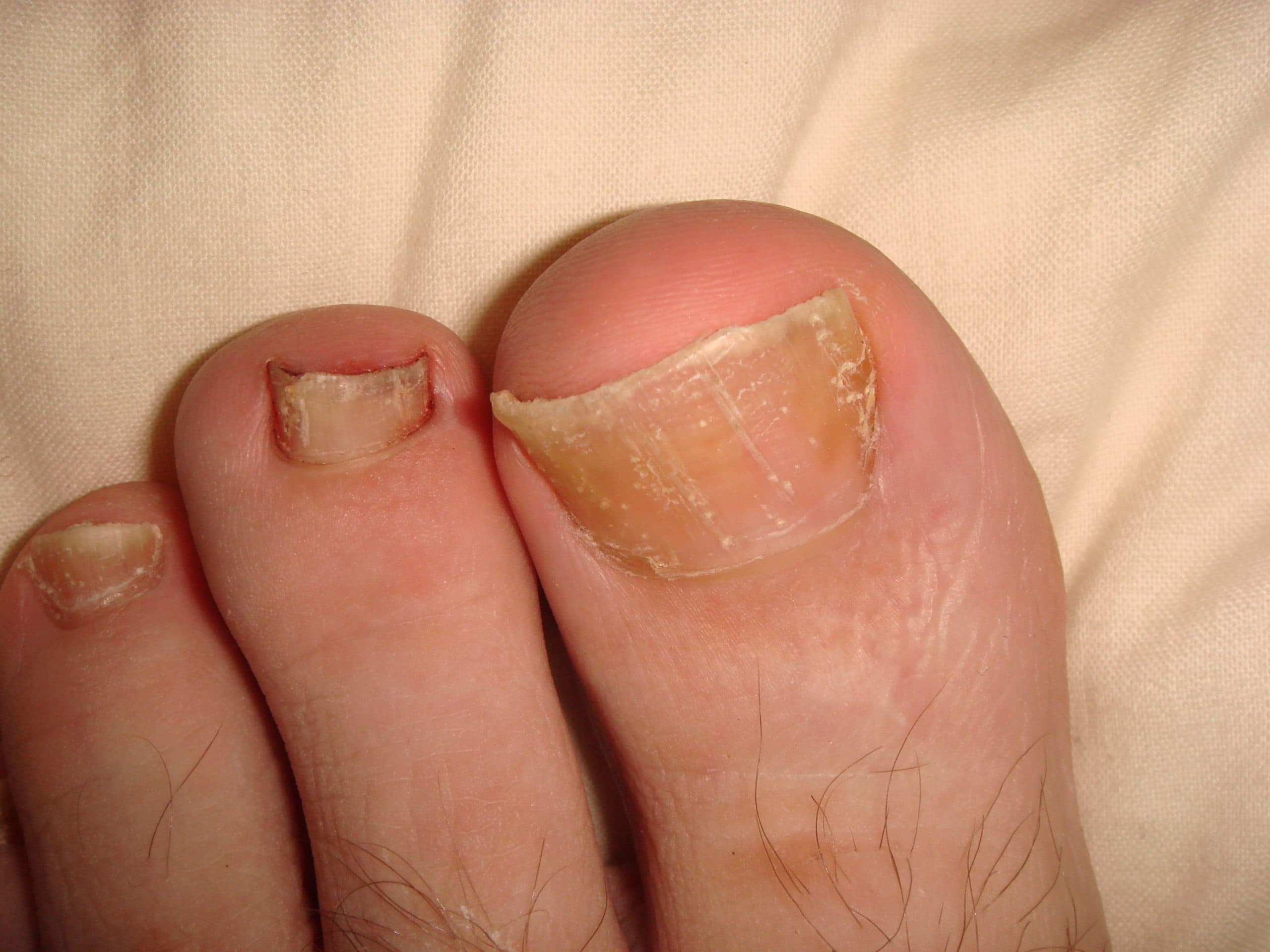 Nail psoriasis on the toenails showing thickened, yellowed and crumbling nails with deformed surface.