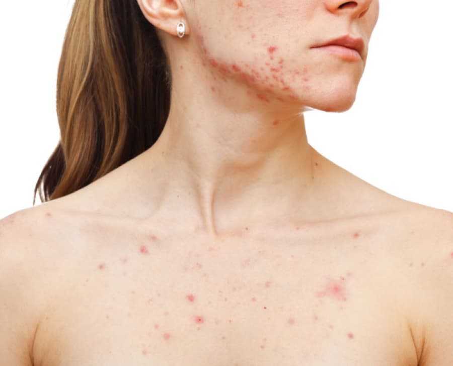 Inflammatory acne with red breakouts across a woman's face, neck and upper chest.