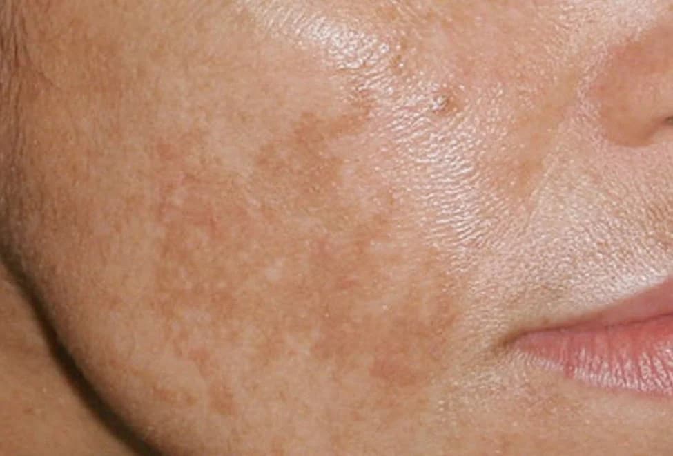 Brownish pigment patches on the cheek skin indicating facial hyperpigmentation.