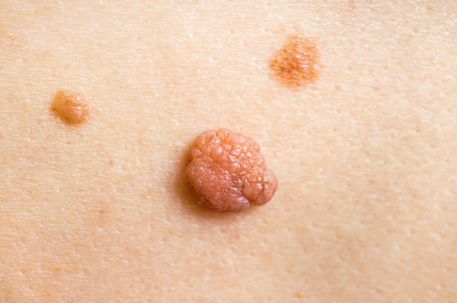 Skin papilloma and moles Raised papilloma and two pigmented moles on the skin, common skin growths assessed during a dermatology consultation.